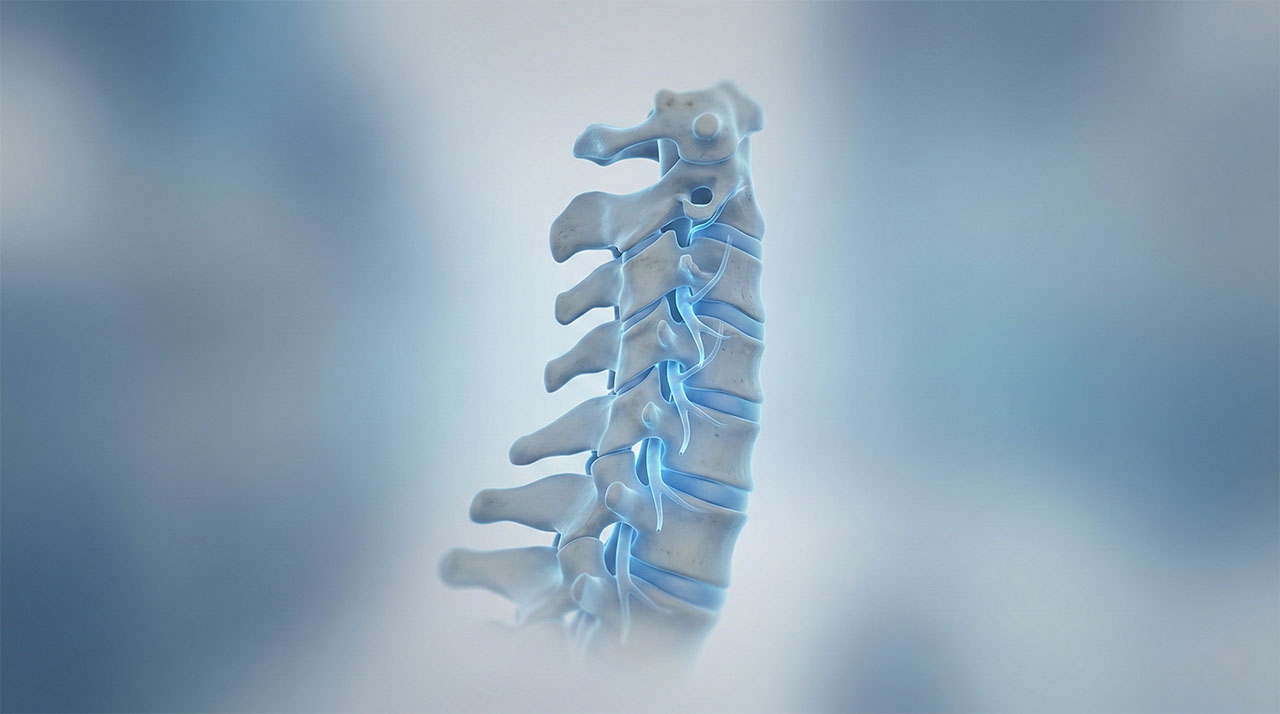 Medical illustration of the cervical spine showing nerve compression in the neck.